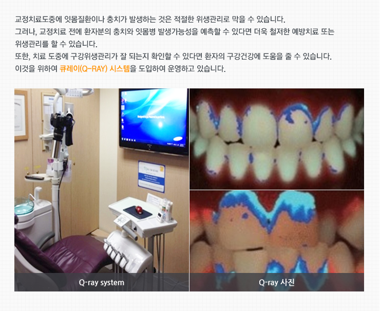 교정치료도중에 잇몸질환이나 충치가 발생하는 것은 적절한 위생관리로 막을 수 있습니다. 
그러나, 교정치료 전에 환자분의 충치와 잇몸병 발생가능성을 예측할 수 있다면 더욱 철저한 예방치료 또는 위생관리를 할 수 있습니다. 
또한, 치료 도중에 구강위생관리가 잘 되는지 확인할 수 있다면 환자의 구강건강에 도움을 줄 수 있습니다. 
이것을 위하여 큐레이(Q-Ray) 시스템을 도입하여 운영하고 있습니다. 