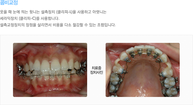 콤비교정   웃을 때 눈에 띄는 윗니는 설측장치 (클리피-L)을 사용하고 아랫니는 
세라믹장치 (클리피-C)를 사용합니다. 
설측교정장치의 장점을 살리면서 비용을 다소 절감할 수 있는 조합입니다.
