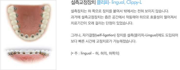 설측교정장치 클리피- lingual, Clippy-L