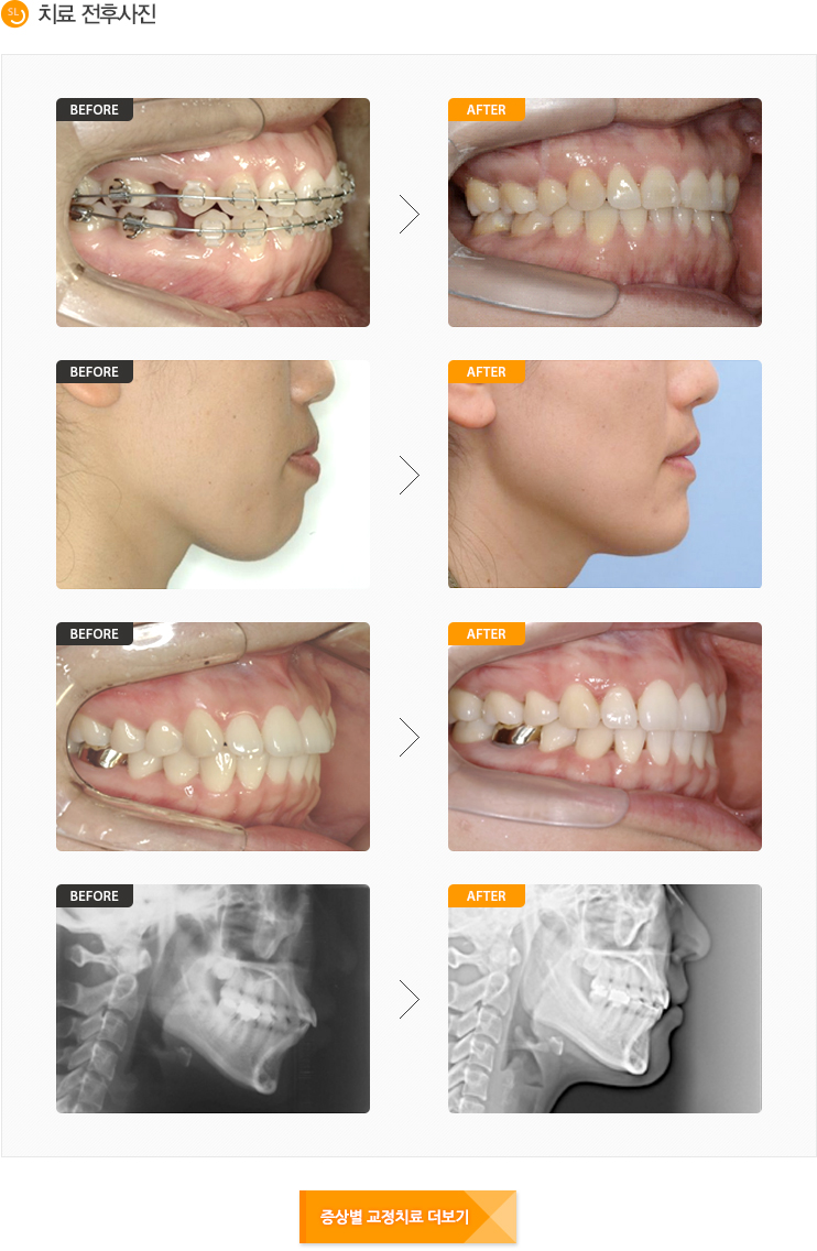 돌출입치료전후사진입니다