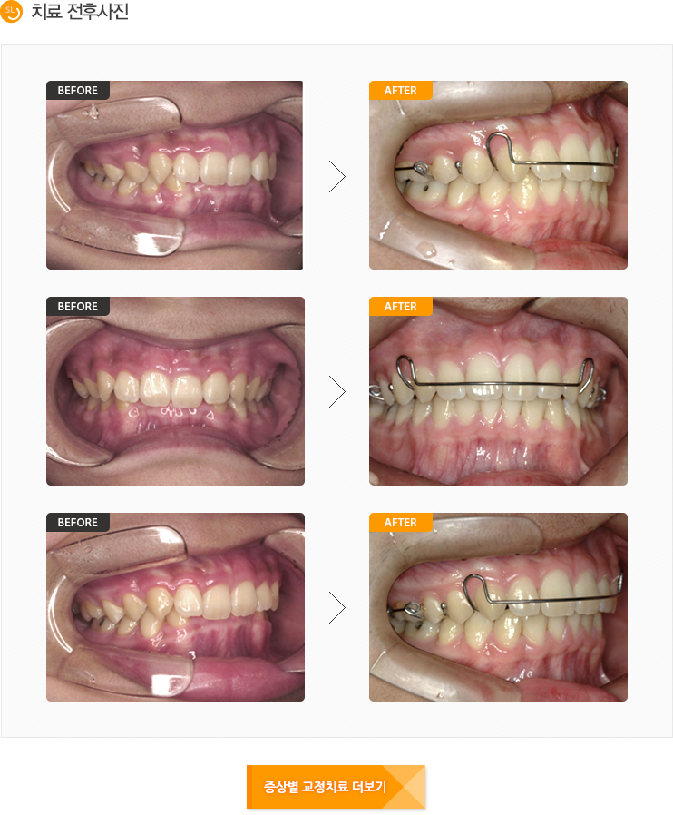 과개교합 전후사진입니다