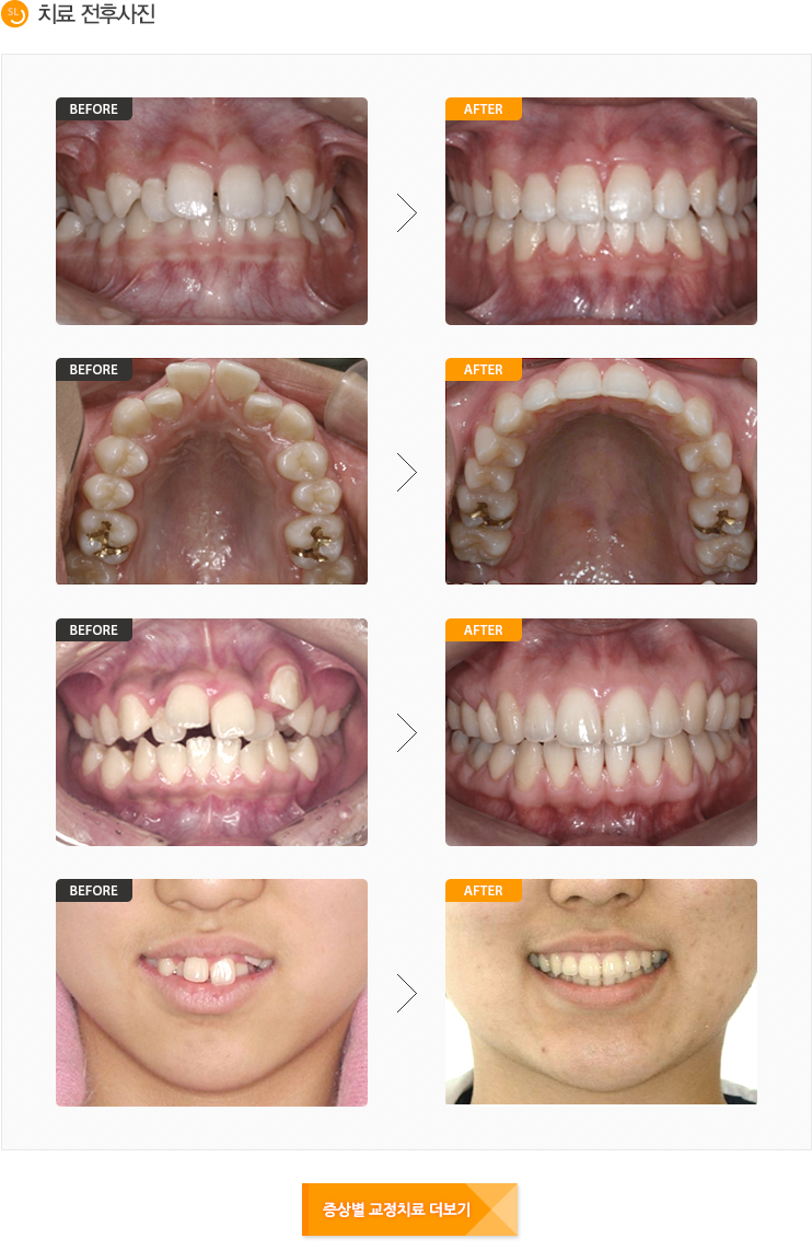덧니교정전후사진입니다