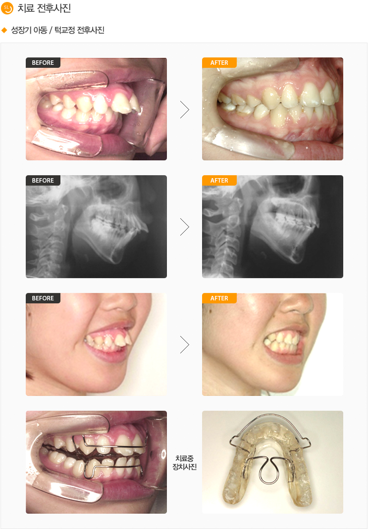 성장기 아동 / 턱교정 전후사진