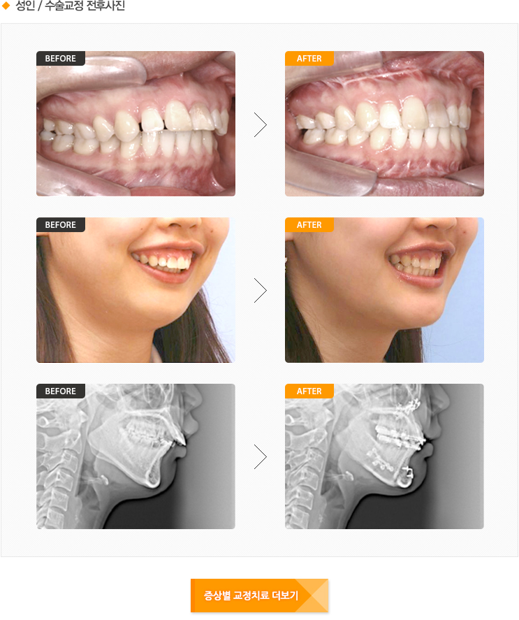 성인 / 수술교정 전후사진
