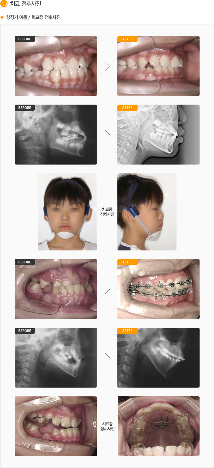 성인 / 수술교정 전후사진 