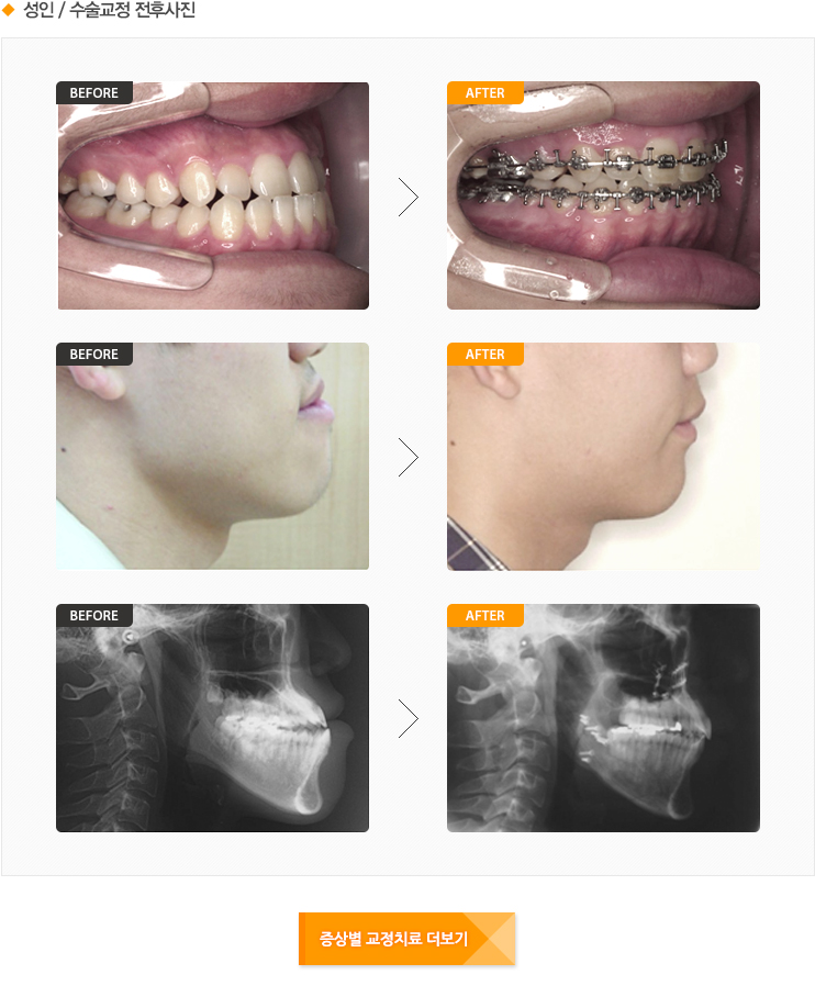 성장기 아동 / 턱교정 전후사진