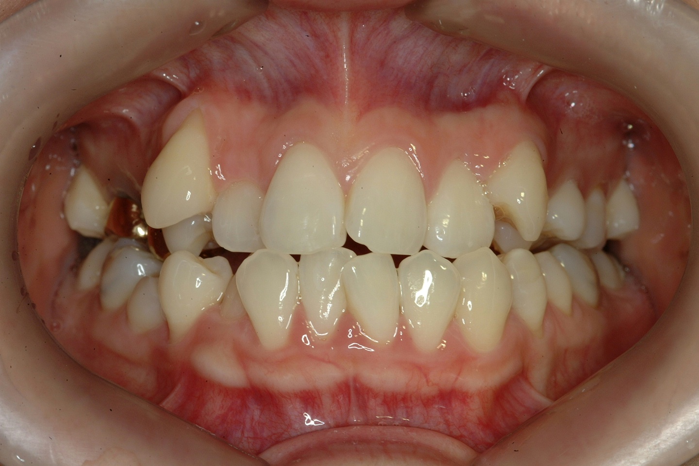 덧니교정치료 전