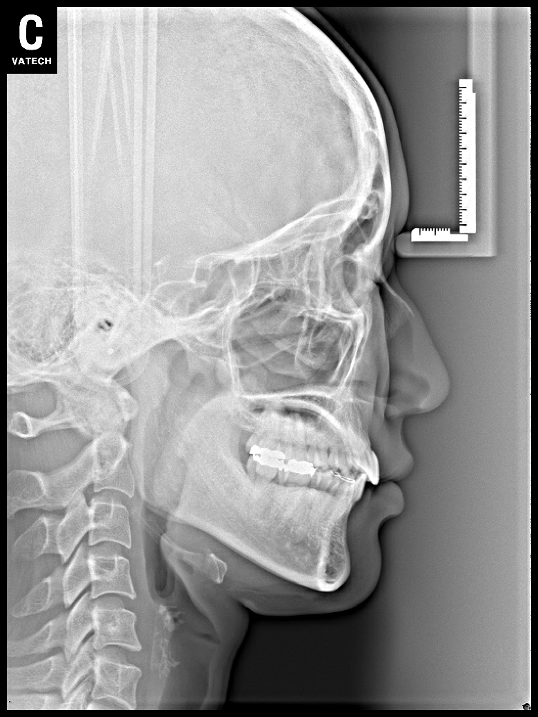 돌출입, 덧니치료 후