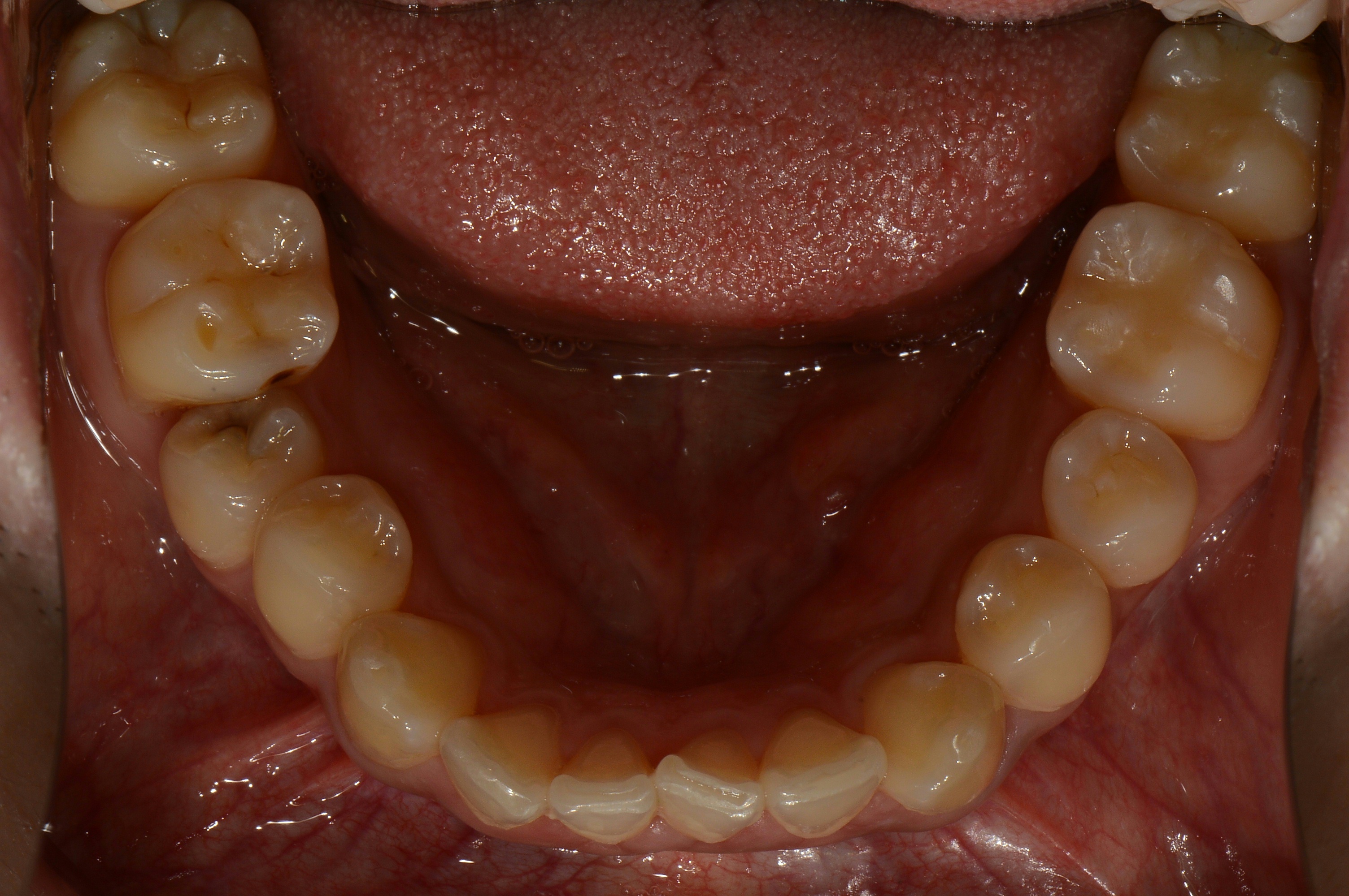 덧니교정치료 전