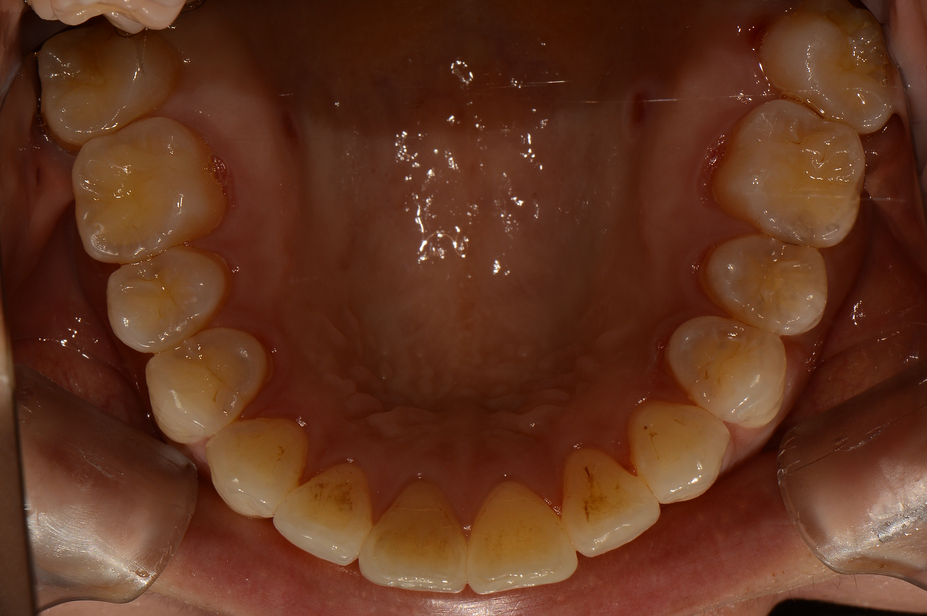 개방교합, 덧니치료 후
